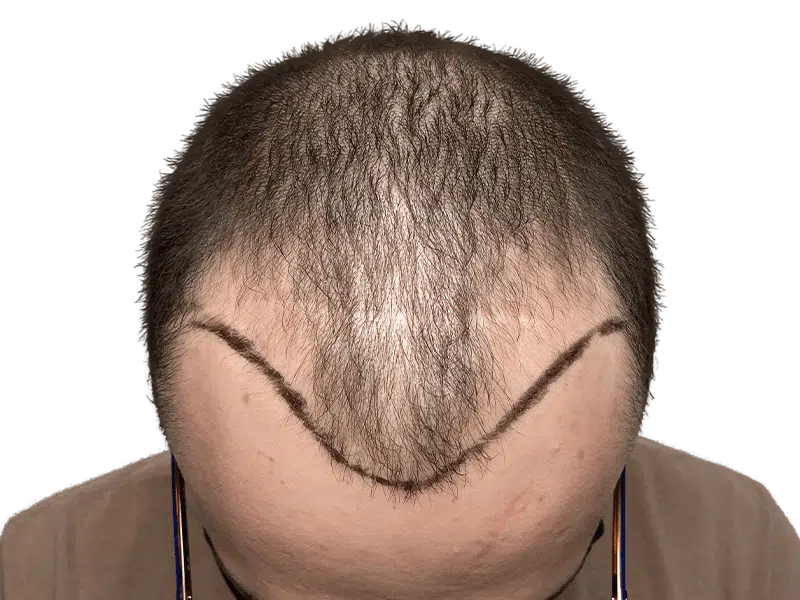 Before hair transplant: Thinning hair, receding hairline marked for restoration. Hair restoration procedure planning.