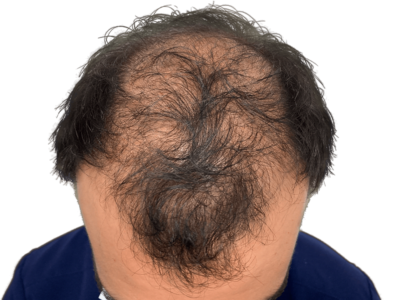Thinning hair, possible male pattern baldness. Consider hair restoration or transplant options for fuller hair.