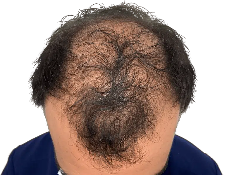 Thinning hair, possible male pattern baldness. Consider hair restoration or transplant options for fuller hair.