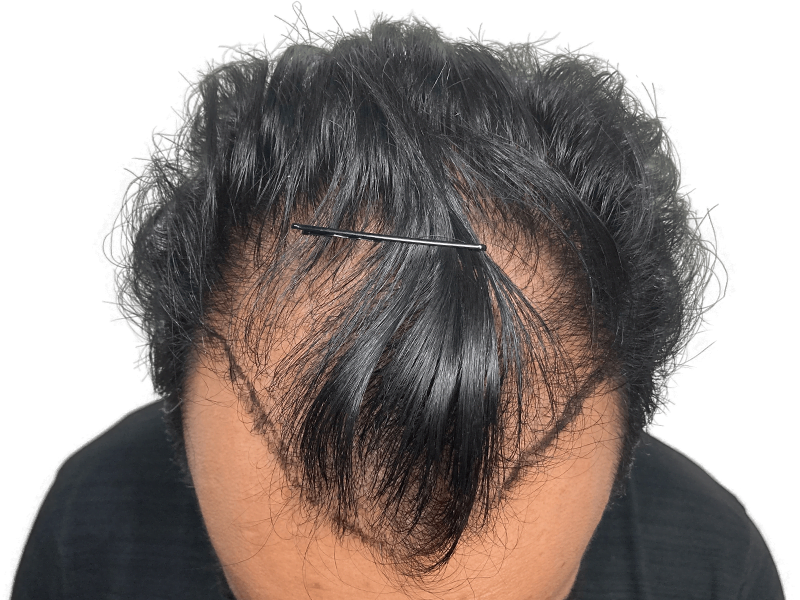 Hair transplant result: Improved hairline and density. Asian man's hair restoration after procedure. Before & after available.