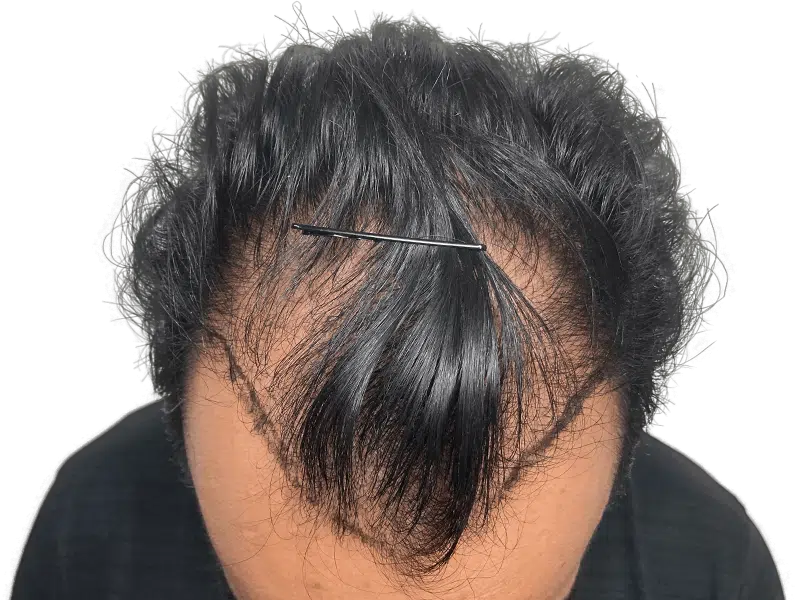 Hair transplant result: Improved hairline and density. Asian man's hair restoration after procedure. Before & after available.
