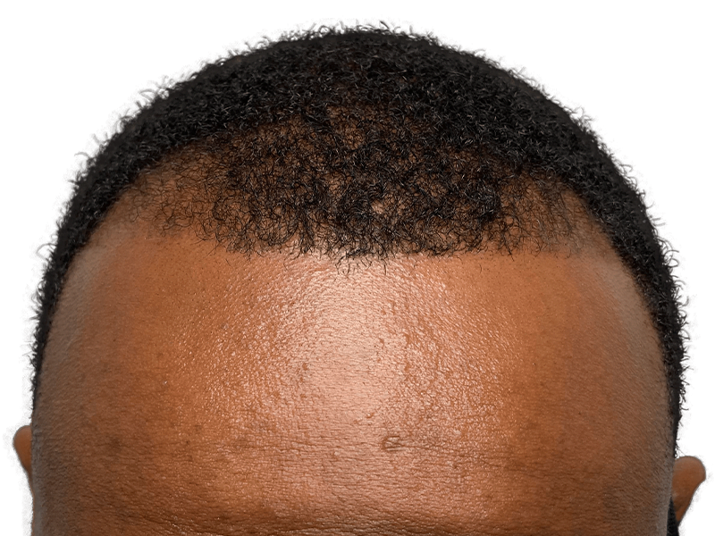 Hair transplant before & after: African American man's receding hairline restored. Hair restoration results.