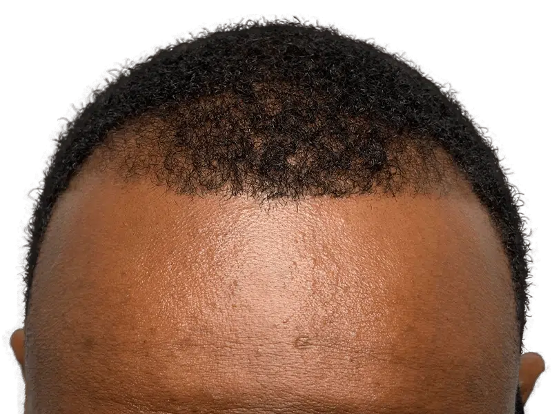 Hair transplant before & after: African American man's receding hairline restored. Hair restoration results.