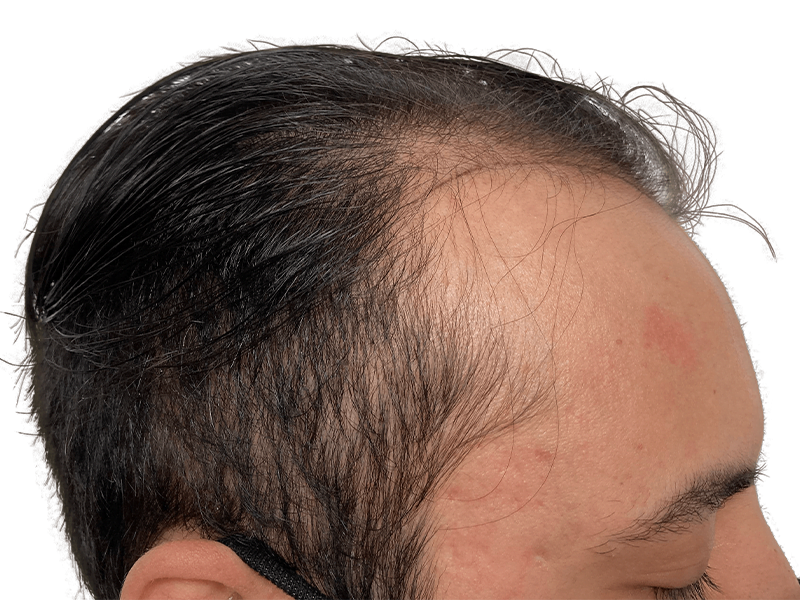 Receding hairline before hair transplant. Dark hair thinning, showing forehead. Hair restoration candidate.