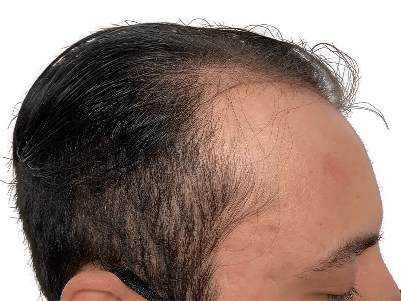 Receding hairline before hair transplant. Dark hair thinning, showing forehead. Hair restoration candidate.