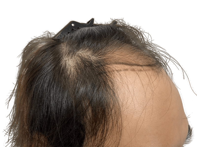 Receding hairline close-up. Potential hair transplant scar. Before hair restoration treatment. Assess hair density & growth.