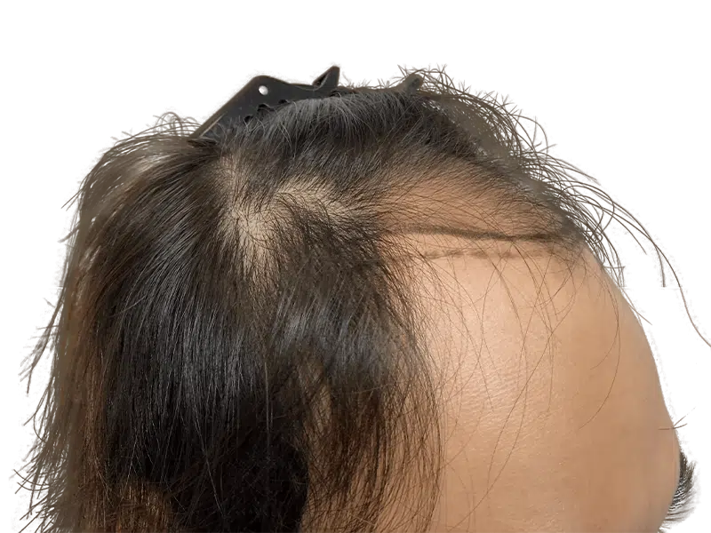 Receding hairline close-up. Potential hair transplant scar. Before hair restoration treatment. Assess hair density & growth.