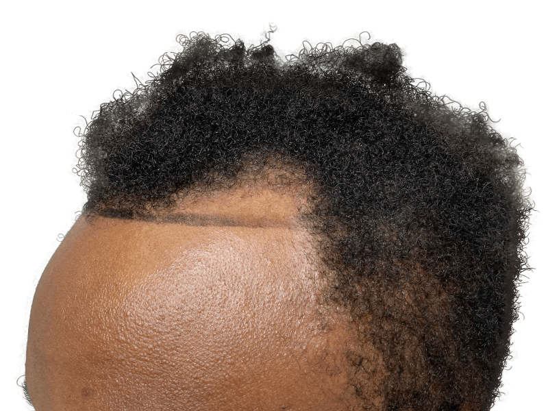 Hair transplant result: African American hairline restored. Before & after showing improved density. Hair restoration success.
