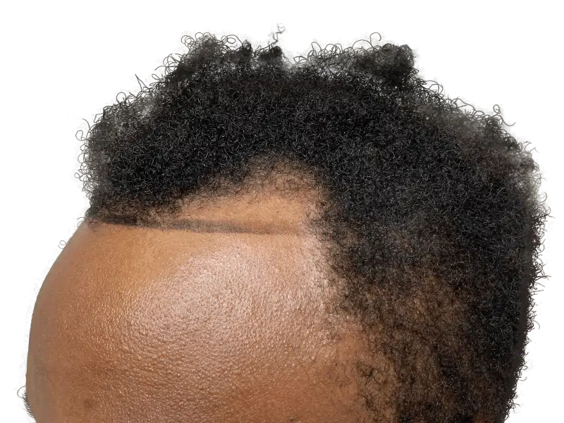 Hair transplant result: African American hairline restored. Before & after showing improved density. Hair restoration success.