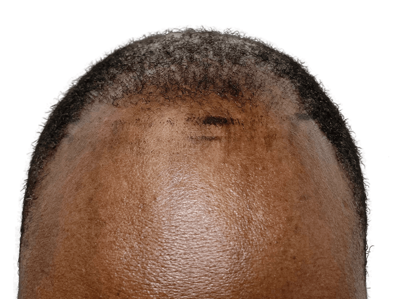 Receding hairline (African American male). Before hair transplant. Hair restoration candidate.