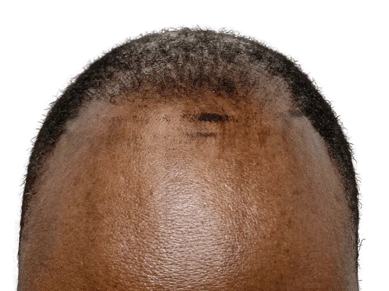 Receding hairline (African American male). Before hair transplant. Hair restoration candidate.