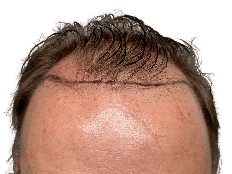 Hair transplant result: Defined hairline achieved with hair restoration. Before & after example of successful procedure.