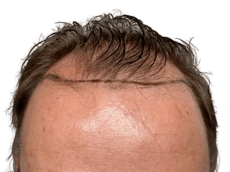 Hair transplant result: Defined hairline achieved with hair restoration. Before & after example of successful procedure.