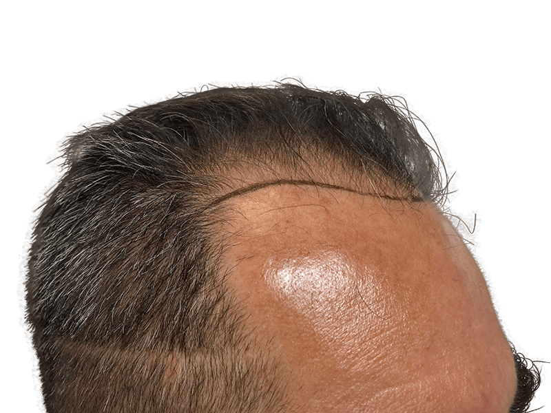 Hair transplant before & after: Restored hairline on Caucasian man. Natural-looking hair restoration results.