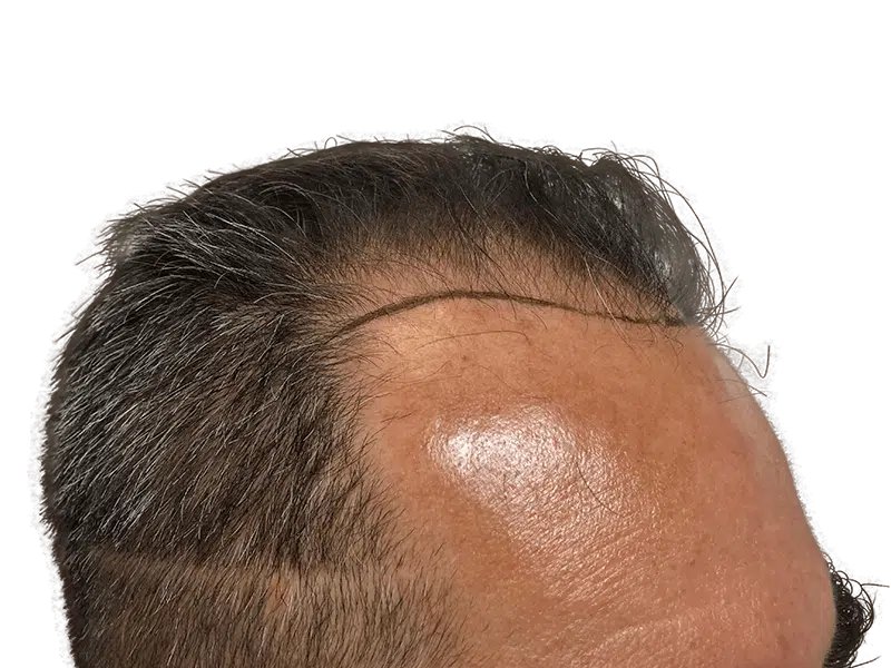 Hair transplant before & after: Restored hairline on Caucasian man. Natural-looking hair restoration results.
