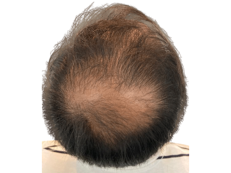 Thinning hair & bald spot on crown. Potential hair transplant candidate. Before hair restoration treatment.