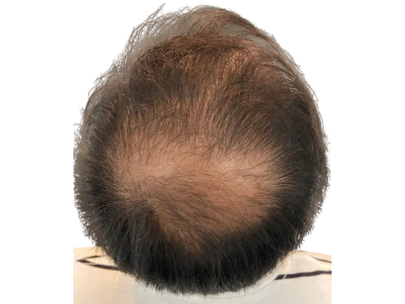 Thinning hair & bald spot on crown. Potential hair transplant candidate. Before hair restoration treatment.