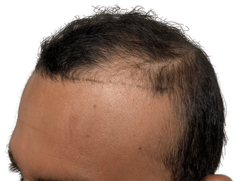 Hair transplant scar on hairline. Hair restoration procedure addressing thinning hair. Before/after results visible.