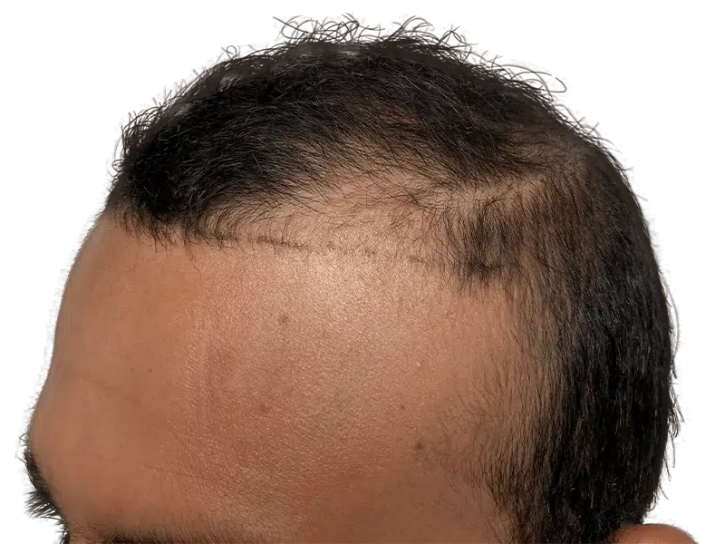 Hair transplant scar on hairline. Hair restoration procedure addressing thinning hair. Before/after results visible.