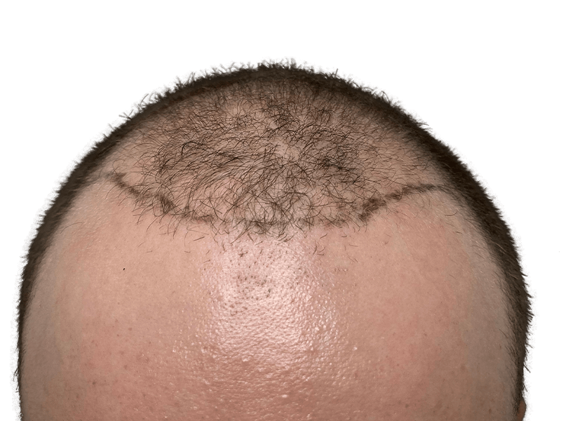 Hair transplant early growth: Light brown hair, showing sparse growth above hairline. Hair restoration procedure visible.