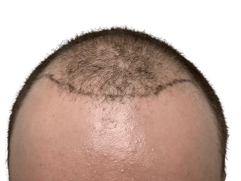 Hair transplant early growth: Light brown hair, showing sparse growth above hairline. Hair restoration procedure visible.