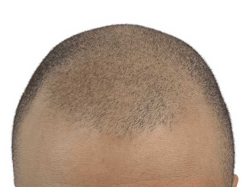 Hair transplant result: Sparse hair on top of head. Possible before/after of hair restoration procedure.