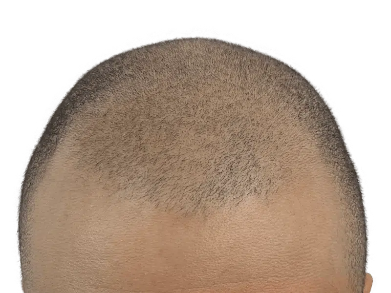 Hair transplant result: Sparse hair on top of head. Possible before/after of hair restoration procedure.