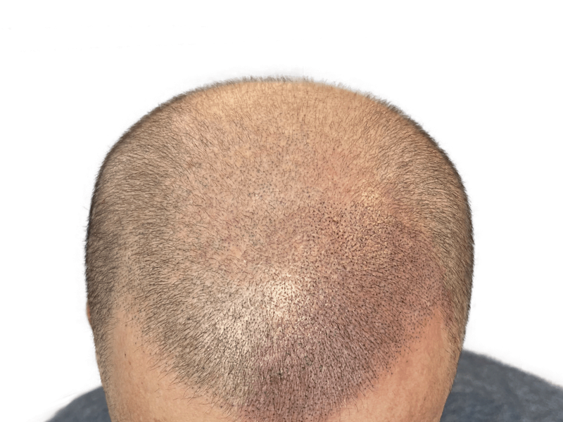 Hair transplant result: Man's scalp showing restored hair growth after procedure. Improved density, natural look.