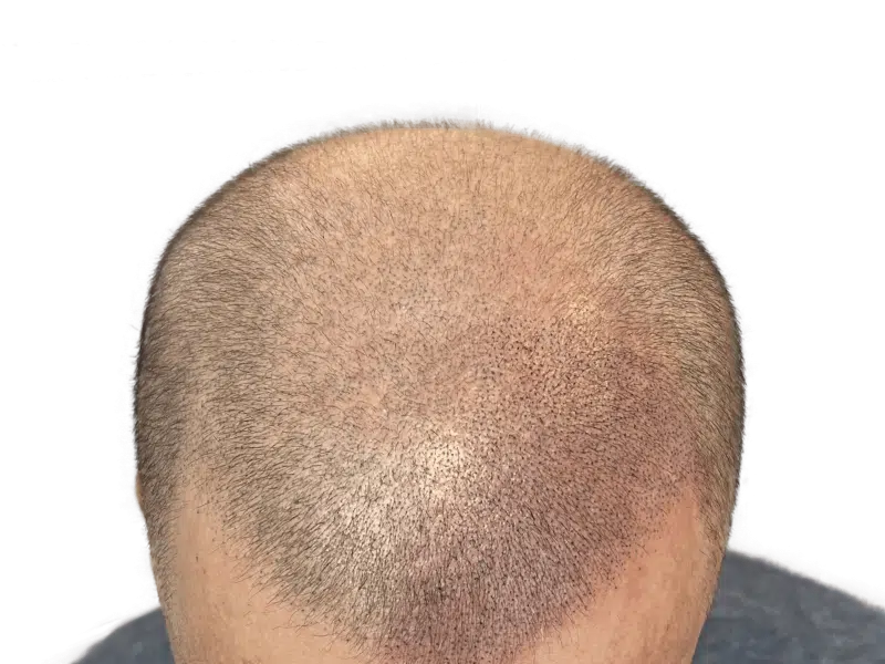 Hair transplant result: Man's scalp showing restored hair growth after procedure. Improved density, natural look.