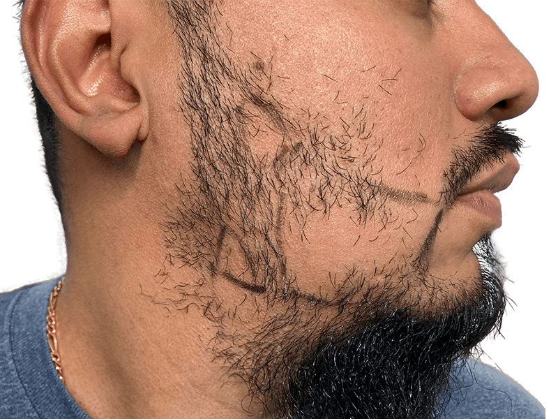 Beard transplant planning: Hispanic man with sparse beard marked for hair restoration. Visualize potential beard density after procedure.