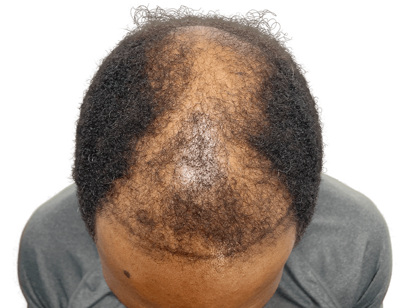 Hair loss progression in Black man: thinning crown & temples. Consider hair restoration or transplant options.
