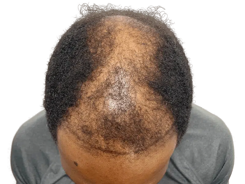 Hair loss progression in Black man: thinning crown & temples. Consider hair restoration or transplant options.