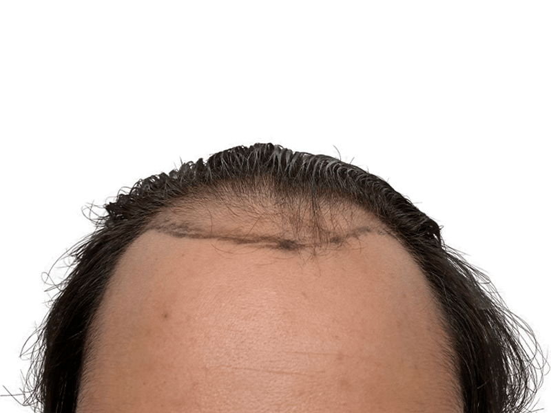 Hair transplant scar on hairline. Dark hair, thinning. Hair restoration procedure result. Before/after potential.