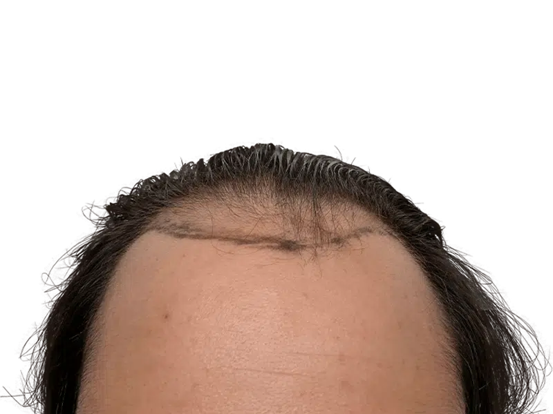 Hair transplant scar on hairline. Dark hair, thinning. Hair restoration procedure result. Before/after potential.