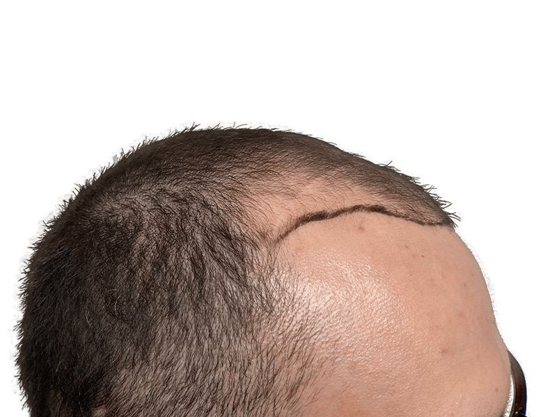 Hair transplant before & after: Receding hairline restored. Dark hair, Caucasian male. Hair restoration results.