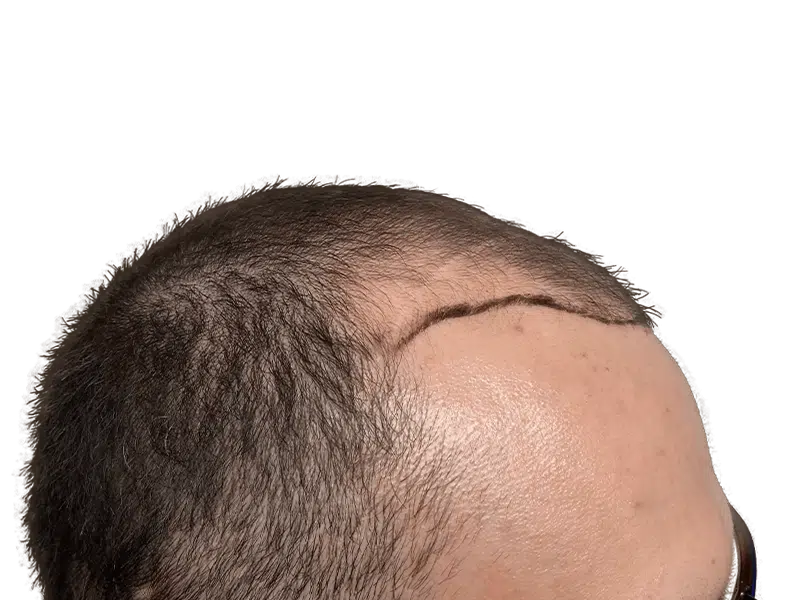 Hair transplant before & after: Receding hairline restored. Dark hair, Caucasian male. Hair restoration results.