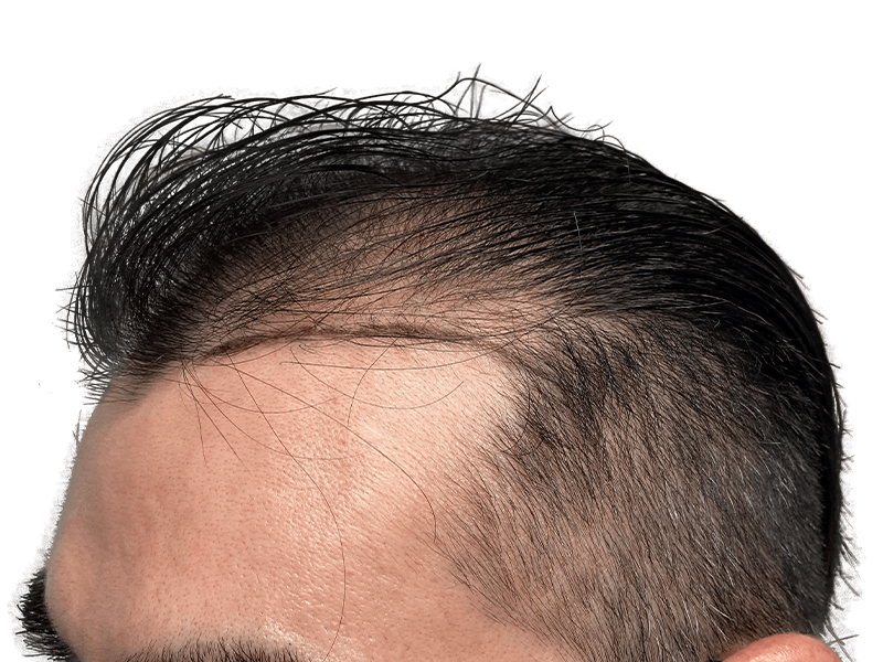 Receding hairline. Hair loss example. Consider hair restoration options. Before hair transplant. Dark hair, thinning at temples.