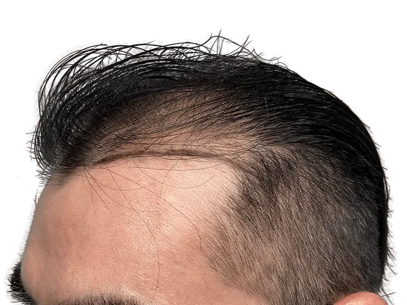 Receding hairline. Hair loss example. Consider hair restoration options. Before hair transplant. Dark hair, thinning at temples.