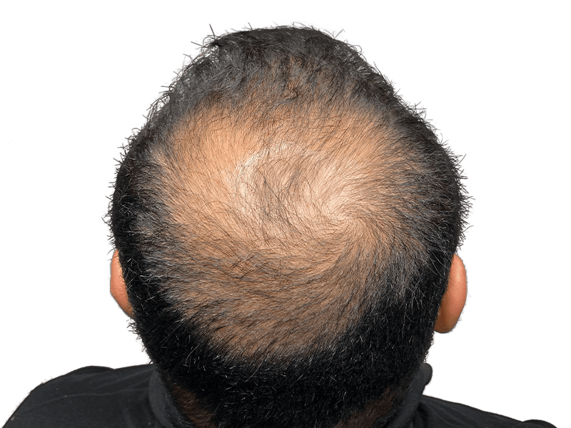 Balding head: thinning hair at the crown. Hair restoration or transplant consultation needed. Before treatment example.
