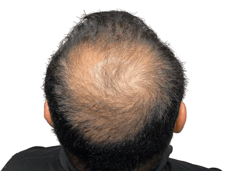 Balding head: thinning hair at the crown. Hair restoration or transplant consultation needed. Before treatment example.