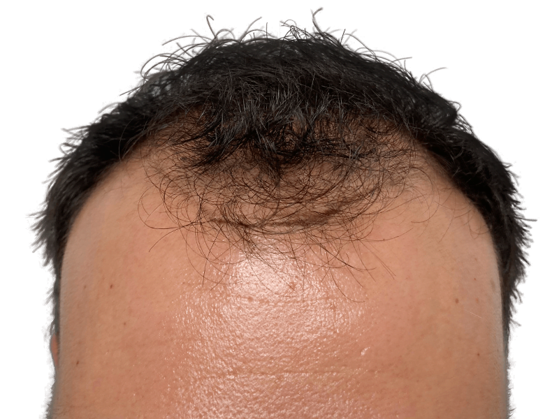 Before hair transplant: Receding hairline on dark-haired individual. Hair restoration candidate. Thinning hair visible.