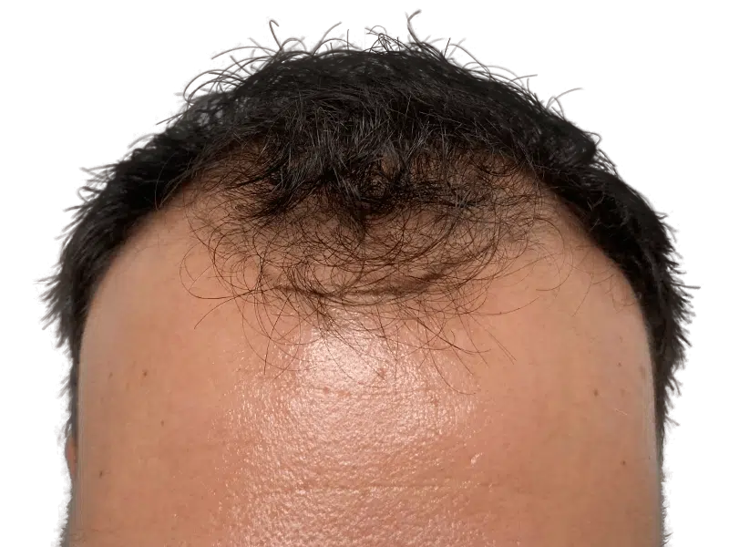 Before hair transplant: Receding hairline on dark-haired individual. Hair restoration candidate. Thinning hair visible.