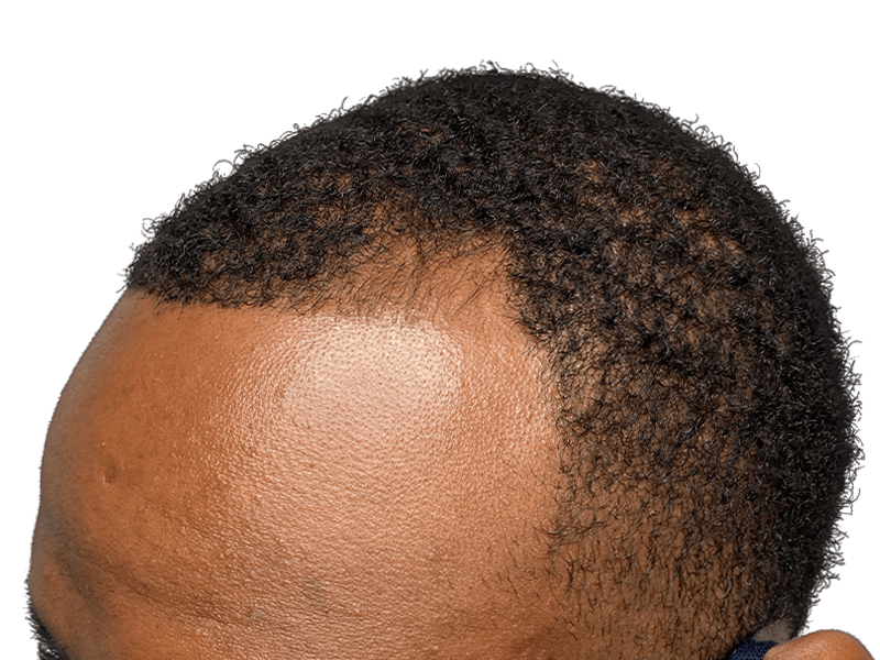 Hair restoration result: African American male hairline. Possible hair transplant. Receding hairline improvement.