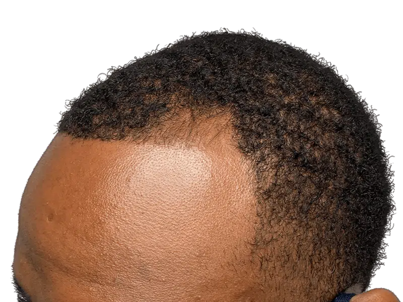 Hair restoration result: African American male hairline. Possible hair transplant. Receding hairline improvement.