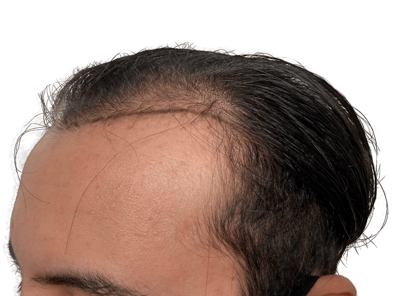 Before hair transplant: Receding hairline on Caucasian man. Hair thinning at temples. Hair restoration candidate.