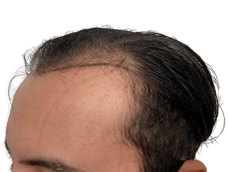 Before hair transplant: Receding hairline on Caucasian man. Hair thinning at temples. Hair restoration candidate.