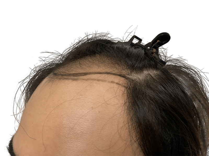Hair transplant result: Asian man's hairline showing improved density. Before & after hair restoration procedure.