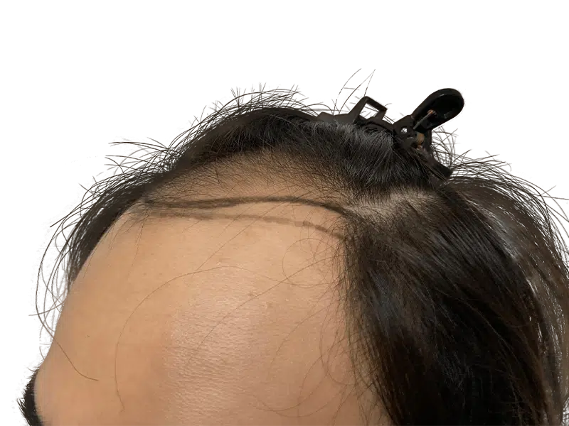 Hair transplant result: Asian man's hairline showing improved density. Before & after hair restoration procedure.