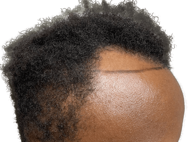 Hair transplant result on African American man. Clear hairline demarcation shows restored density. Hair restoration success.