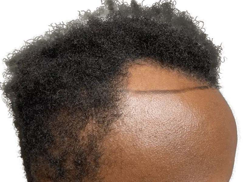 Hair transplant result on African American man. Clear hairline demarcation shows restored density. Hair restoration success.